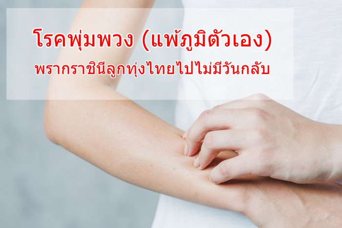 โรคพุ่มพวง หรือโรคแพ้ภูมิตัวเองเกิดจากอะไร