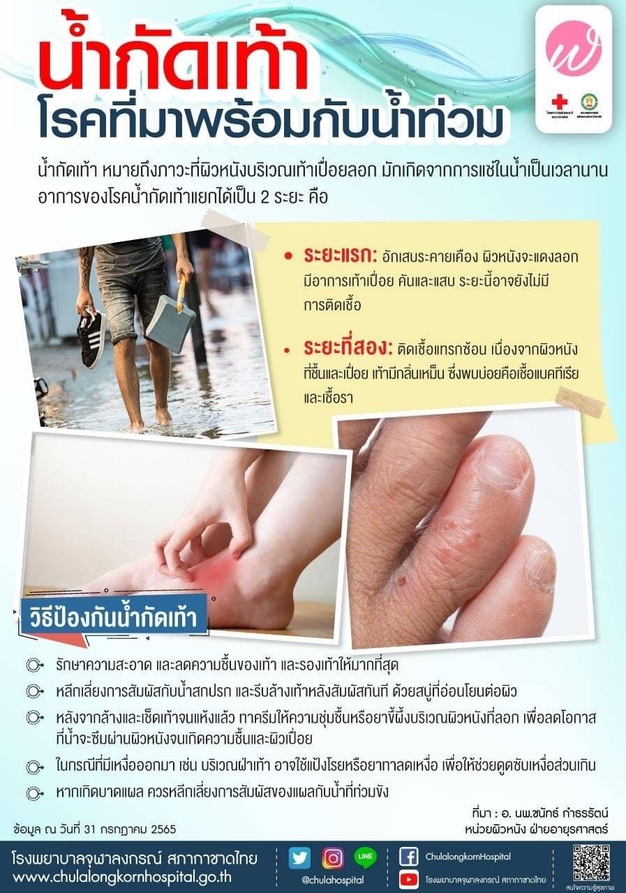 น้ำกัดเท้า โรคที่มาพร้อมกับน้ำท่วม
