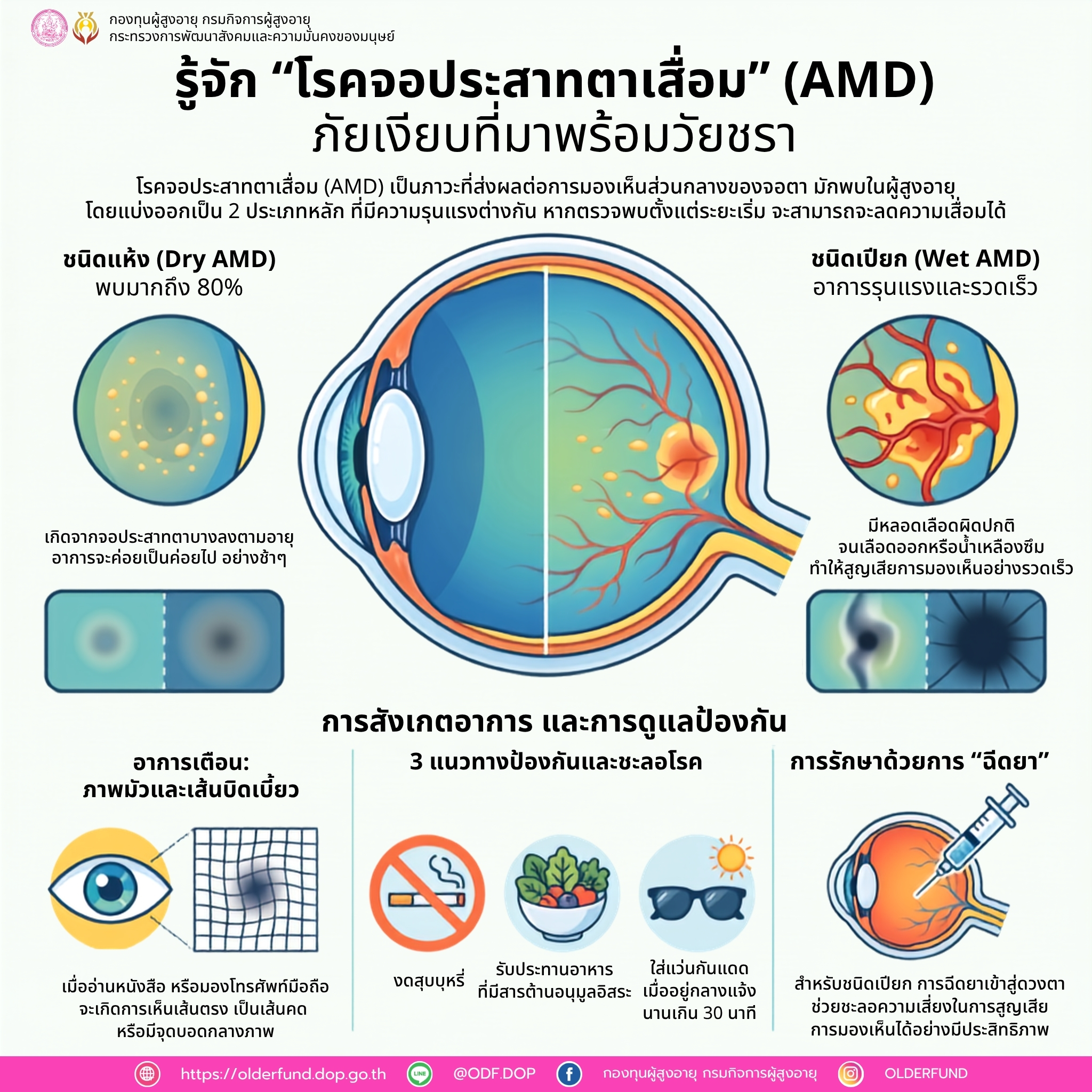 โรคจอประสาทตาเสื่อมในผู้สูงอายุ (Age-related Macular Degeneration: AMD)